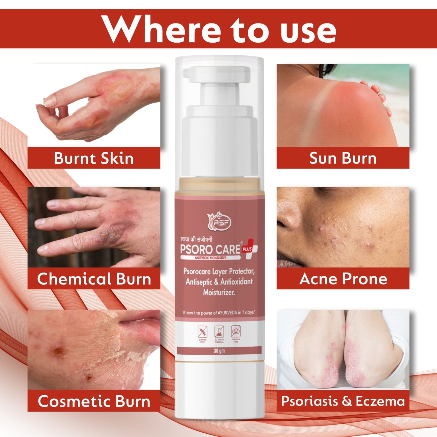 Psorocare Ayurvedic Layer Protector For Psoriasis And Eczema | Aids in Redness, Irritation and Minor Skin Cut | For Sun Burn, Acne Prone, Cosmetic Burn 30 GM | Pack of 1