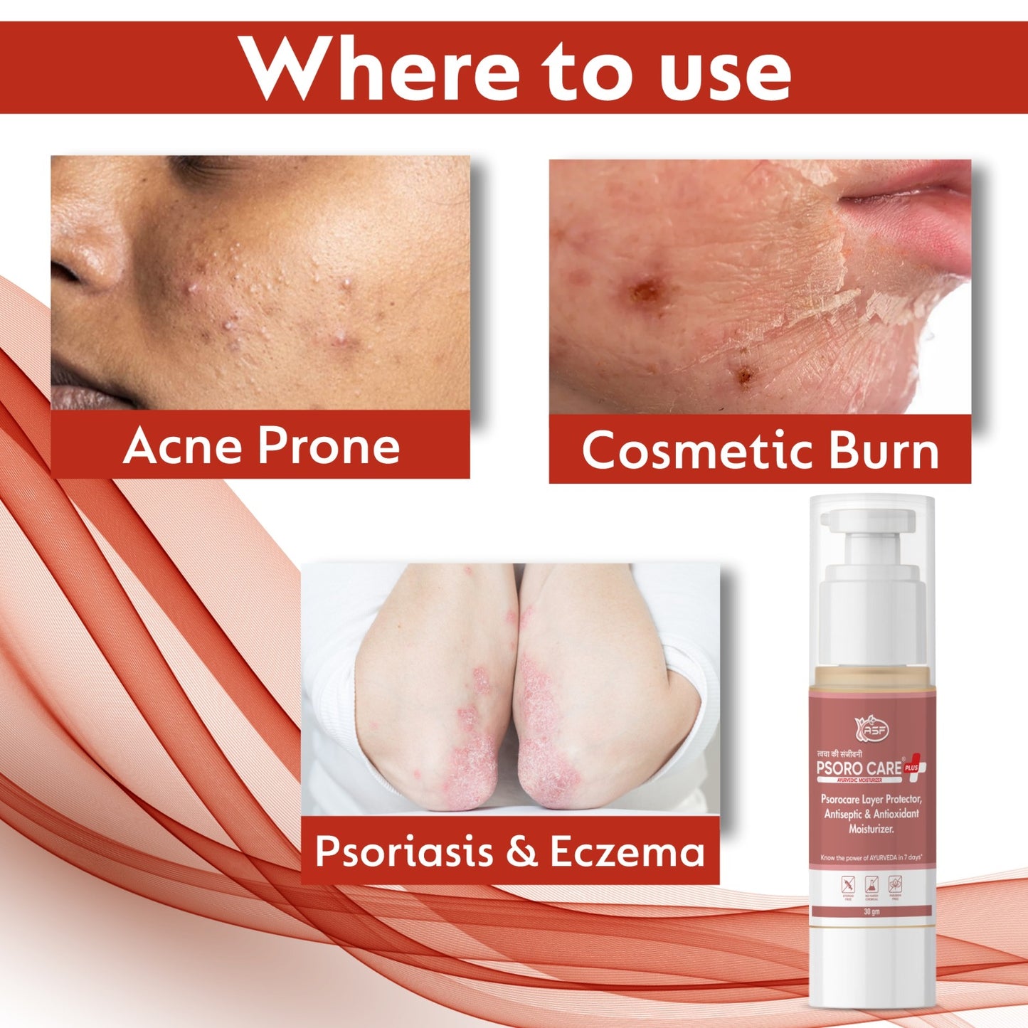 Psorocare Ayurvedic Layer Protector For Psoriasis And Eczema | Aids in Redness, Irritation and Minor Skin Cut | For Sun Burn, Acne Prone, Cosmetic Burn 30 GM | Pack of 1